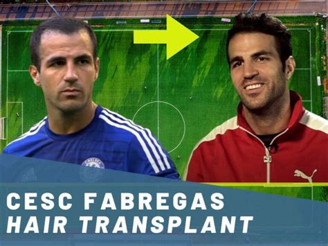 Cesc Fabregas Hair Transplant Hair Loss Technical Analysis