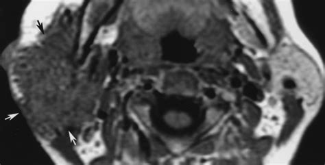 Parotid Masses Prediction Of Malignancy Using Magnetization Transfer