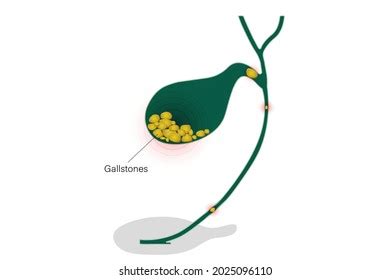 Gallbladder Stones Stock Photos and Pictures - 1,595 Images | Shutterstock