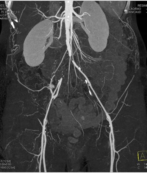 Leriche syndrome causes, symptoms, diagnosis, treatment & prognosis