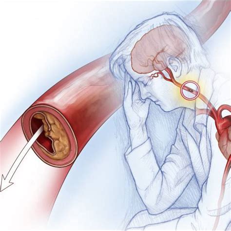 Why Is Sex After Menopause Sometimes More Painful Mayo Clinic News Network