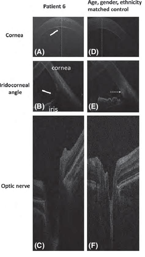 Spectral Domain Optical Coherence Tomography Of Case 6 With Primary