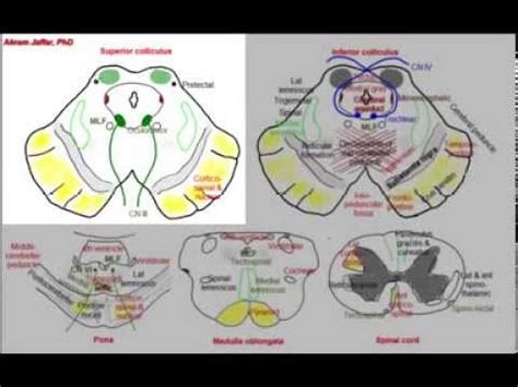 Benedikt Syndrome