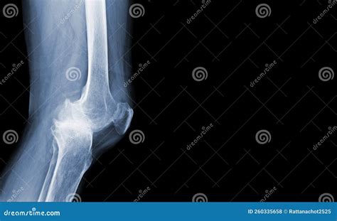 X Ray Of Human Knee Severe Osteoarthritis Of The Knee Normal Ligaments