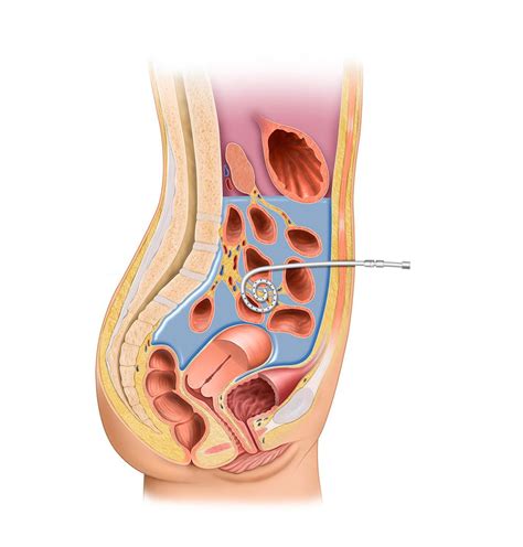 Understand the Peritoneal Dialysis Catheter