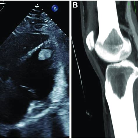 A Transthoracic Echocardiogram Apical Chamber View Demonstrating