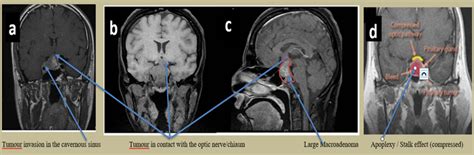 Non Functional Pituitary Adenoma Wapo