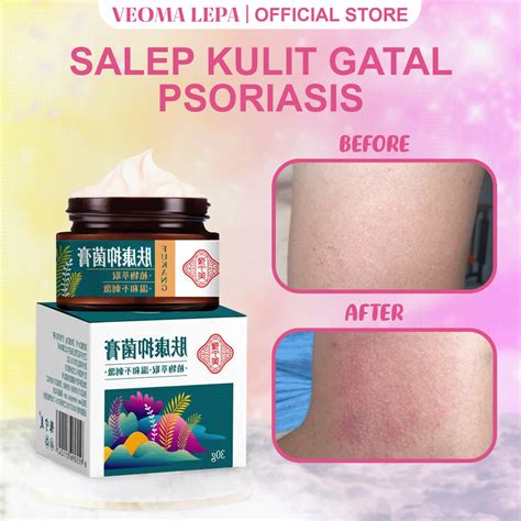 Jual Obat Gatal Salep Eksim Salep Psoriasis Originnal Salep Kulit