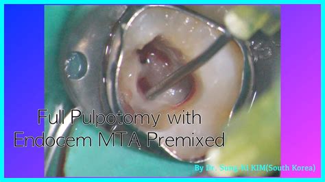 Full Pulpotomy As A Vital Pulp Therapy On Permanent Tooth With Endocem