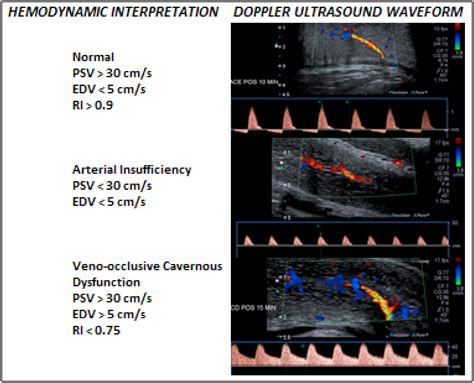 SciELO Brasil Standardization Of Penile Hemodynamic Evaluation