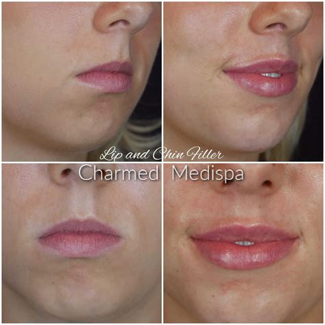 Lip Fillers Charmed Medispa