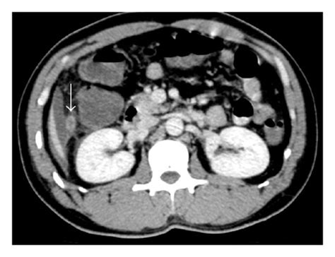 Transverse Image Of The Contrasted CT Scan Showing The Subhepatic