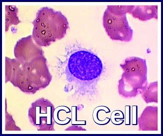 Hairy Cell Leukemia - Ask Hematologist | Understand Hematology