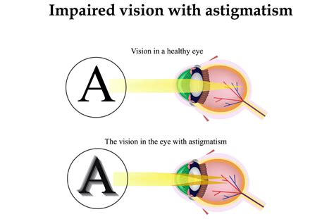 What Are the Best Contacts for Astigmatism? | Washington