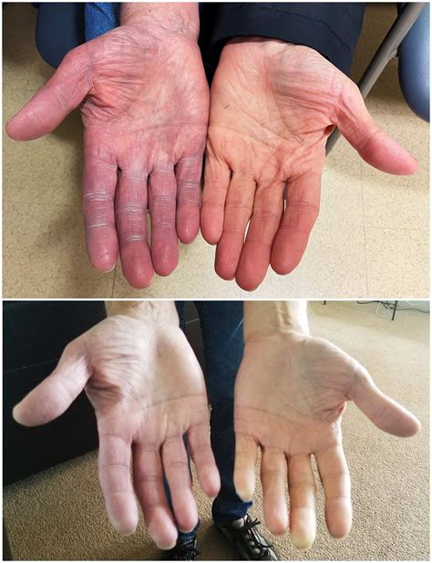 Peripheral Cyanosis