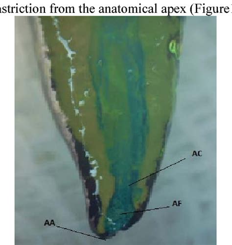 Figure From Evaluation Of The Distance Of Apical Constriction From