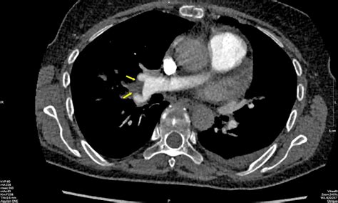 MSCT Of The Thorax Showing Small Residual Thrombotic Masses MSCT