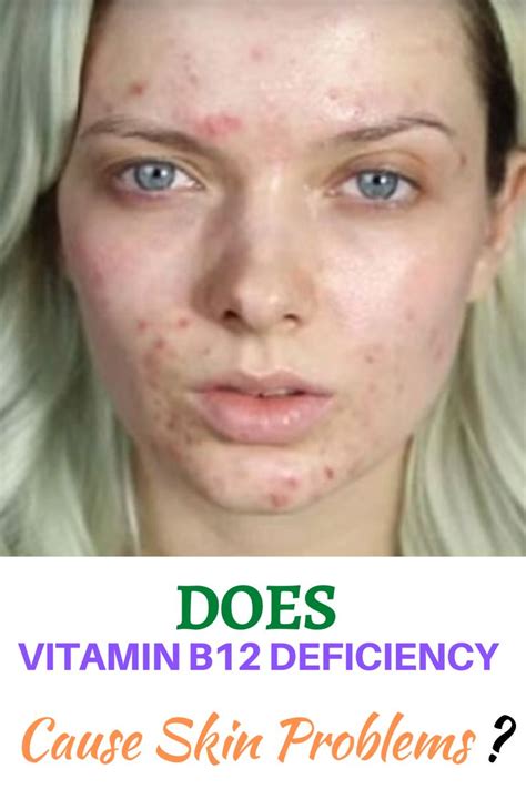 Vitamin A Deficiency Skin Rash