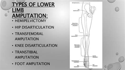 Lower limb amputation