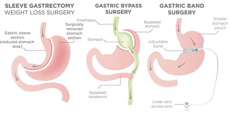 Gastric Sleeve Vs Gastric Bypass Vs Lap Band Surgery