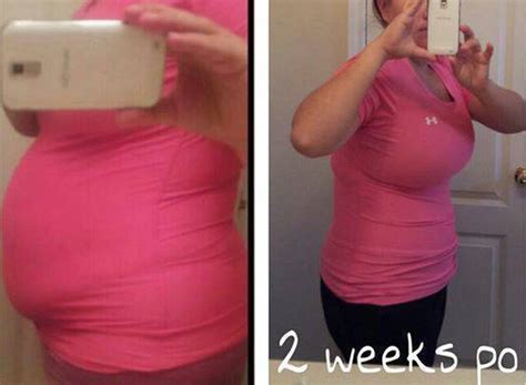 Pics Tummy Tuck And Lipo Before And After Tummy Tuck Prices Photos