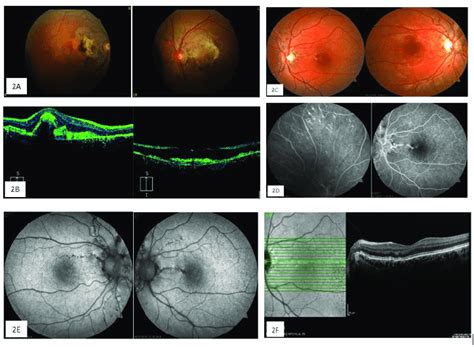 In Ophthalmic Examination Of The First Case Color Fundus Photography