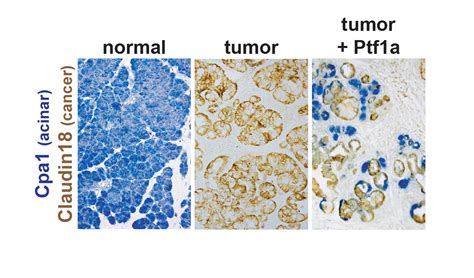 Cellular Origins Of Pancreatic Cancer Discovery And Innovation At University Of Utah Health