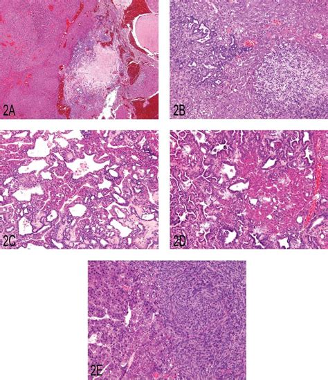 A Primary Liver Neoplasm Demonstrating The Classic Presentation Of A Download Scientific