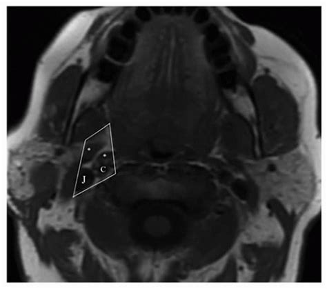 Tumors of the Parapharyngeal Space | Oncohema Key