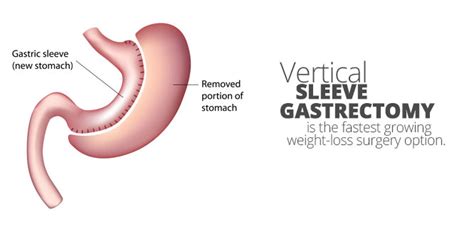 Laparoscopic Vertical Sleeve Gastrectomy | Aloha Surgery | Weight Loss ...