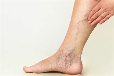 How To Prevent Spider Veins In Sydney Tips And Tricks