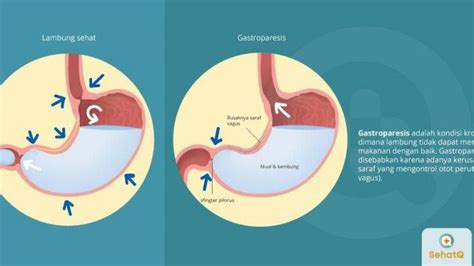 Gastroparesis Keadaan Ketika Lambung Tidak Bisa Mencerna Makanan