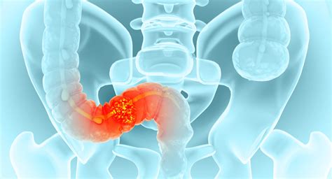 Can Ctdna Directed Therapy Improve Outcomes In Low Risk Colon Cancer Physician S Weekly