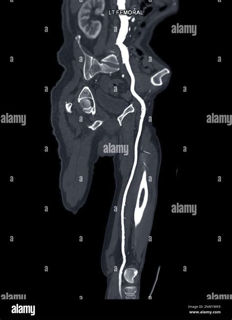 Cta Femoral Artery Run Off Mpr Curve Showing Left Femoral Artery For Diagnostic Acute Or Chronic