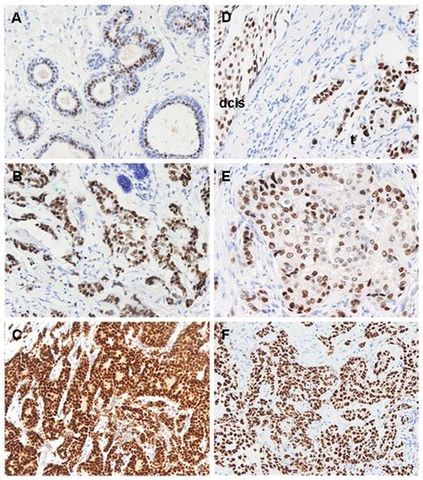 GATA3 Immunohistochemical Staining Patterns In Different Types Of