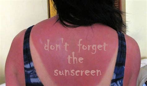 You Didnt Use Sunscreen And Now Youre A Lobster Heres 6 Ways To