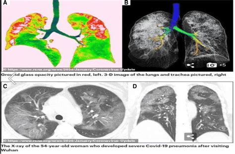 X-ray image of a patient with severe COVID-19 pneumonia (Source: RNSA) | Download Scientific Diagram