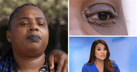 Dr Pimple Popper Where Is Ebonee Now Dr Sandra Lee Helps Patient