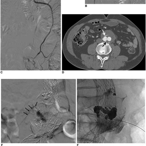 Steps For Endoleak Repair Via Transabdominal Approach With Type Ll