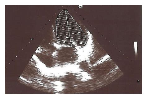 Transthoracic echocardiography revealed global hypokinesia of the LV ...