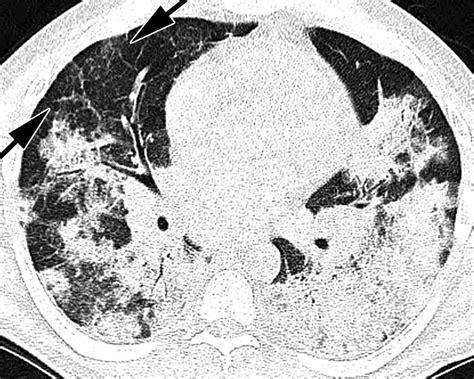 State Of The Art Imaging Of Occupational Lung Disease Radiology