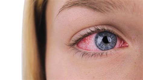 Corneal Abrasion Symptoms And Treatment Shreya Eye Centre