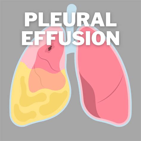 What Is A Pleural Effusion The Halpern Law Firm