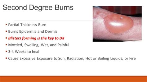 Second Degree Burns Blister Burns Causes And Effects