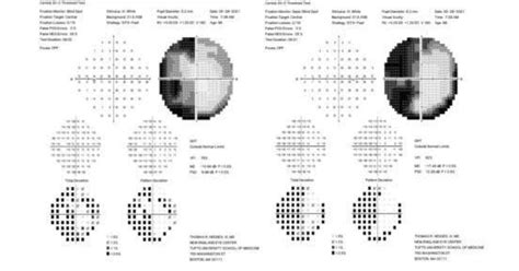 Hemianopsia Tbi Rehabilitation