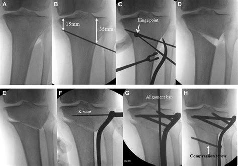 Hybrid Cwhto Process Examined Under Fluoroscopy A The Surgical