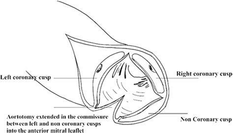 Aortotomy extension into AML for Manouguian procedure (illustrated by ...