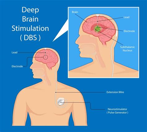 Deep Brain Stimulation Parkinsons Treatment Medicare Solutions Blog