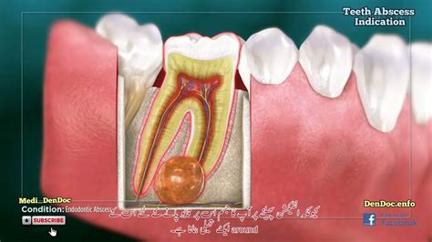 Tooth Abscess Cause Of Gum Infection Jaw Bone And Teeth Decay