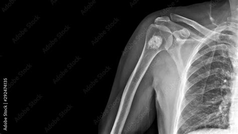 Stockfoto Med Beskrivningen Film X Ray Shoulder Radiograph Show